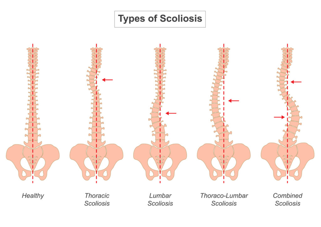 types of scoliosis